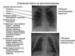 Что значит корни малоструктурные на рентгене?