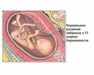 Токсикоз на 15 неделе беременности