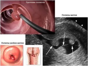 Можно ли избавиться от полипа в матке с помощью курса дюфастона?