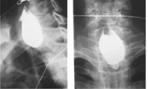 Можно ли делать рентген при проблемах со щитовидкой?