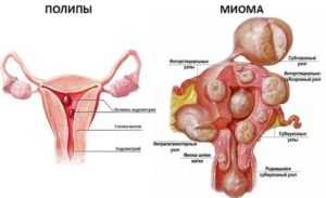 Лечится ли полип матки и эндометриоз?