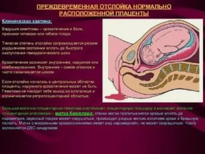 Отек плаценты при беременности