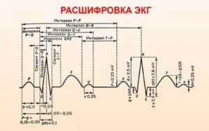 Расшифровка ЭКГ