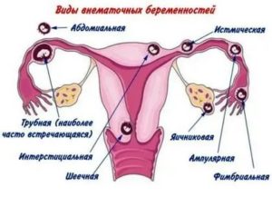 Месячные после внематочной беременности и операции