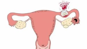 Болезненная менструация после задержки