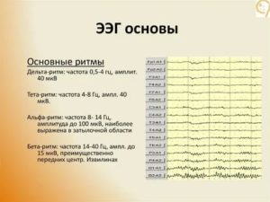 Помогите понять результат ЭЭГ