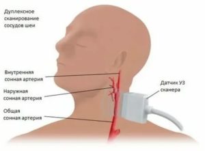 Что такое дуплекс ТК и БЦ сосудов?