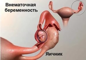 Можно ли проводить аборт при кисте яичника?