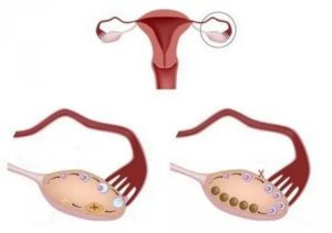 Мультифолликулярные яичники и возможность беременности