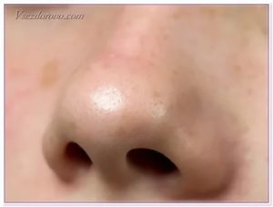 Черные точки на носу у ребенка