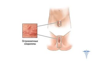 Между влагалищем и анусом образовался какой то нарост кожи