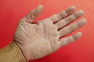 Белый налет и шелушение на кистях рук