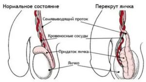 Левое яичко чувствительнее правого,  что это?