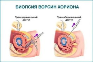 Что означает хорошая биопсия ворсин хориона?