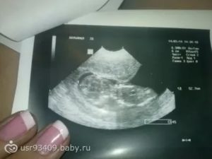 Замершая беременность на сроке 13,5 недель