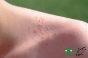 Аллергия на эхинацею
