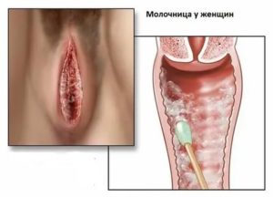 Круглая плотная шишка во влагалище, странные выделения