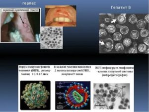 Выявлен вирус герпеса и хламидиоз