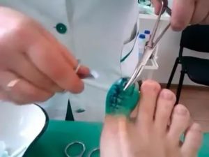 Обработка раны после удаления ногтя