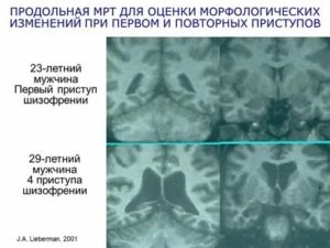 Правда ли, что шизофрению можно определить с помощью МРТ?