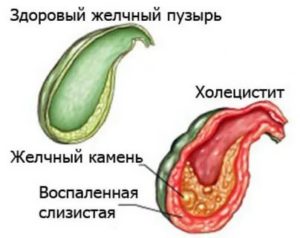 Изжога и воспаление желчного пузыря