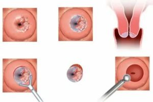 Уколы в шейку матки