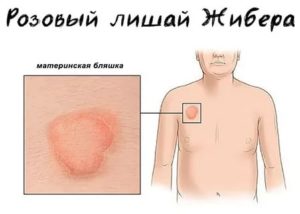 Как понять, что розовый лишай стал более тяжелым?