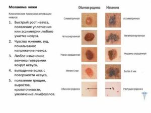 Какие признаки перерождения родинки в злокачественную?