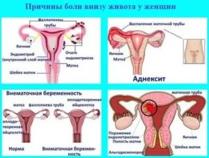 Режет во время месячных сильно низ живота