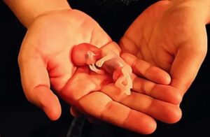 Аборт в 10 недель беременности