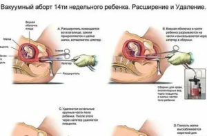 Может ли осмотр у гинеколога спровоцировать выкидыш?