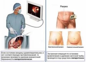 Месячные после внематочной беременности и операции