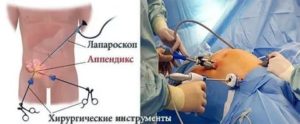 Может ли быть нормой задержка после удаления аппендицита?