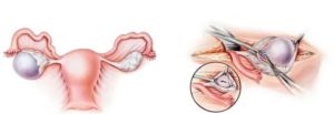 Можно ли проводить аборт при кисте яичника?