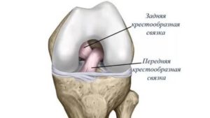 Что такое интралигаментрные повреждения ПКС?
