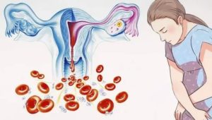 Обильная менструация на фоне приема ОК
