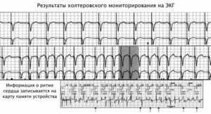 Расшифруйте результаты холтера