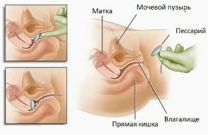 Можно ли вставлять пессарий при молочнице?