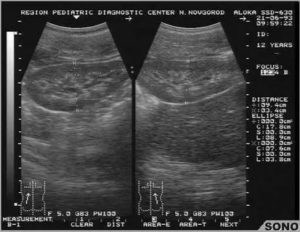 Эхографический синдром перимедуллярного кольца, плохо ли это?