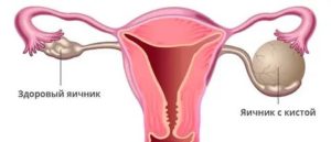 Какие методы контрацепции использовать при кисте яичника?