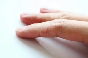 Постоянно трескается кожа на пальцах рук