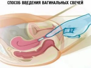 Можно ли заниматься сексом, используя полижинакс и лактожиналь?