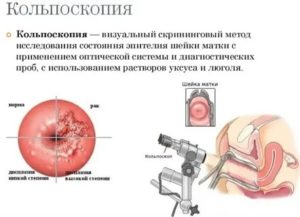 Боль после кольпоскопии