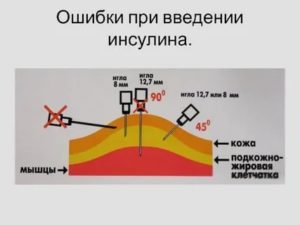 Можно ли уйти от инъекций инсулина?