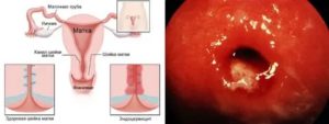 Лечение эрозии шейки матки и  бактериального вагинита
