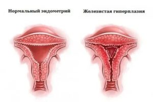 Гиперплазия эндометрия у девочки-подростка