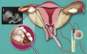 Какие методы контрацепции использовать при кисте яичника?