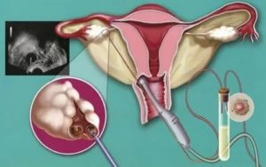 Можно ли проводить аборт при кисте яичника?
