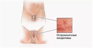 Трещина между половыми губами