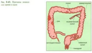 Боль в боку, кровь в кале